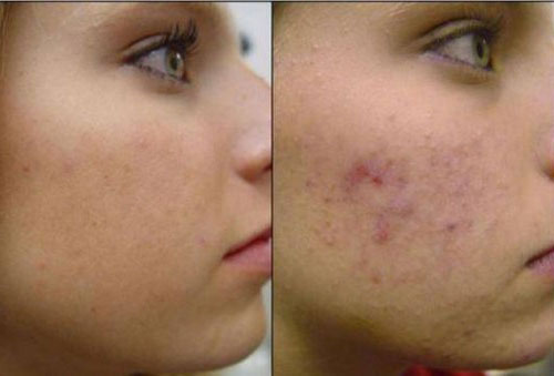 comment utiliser le gel aloe vera sur le visage acne tache