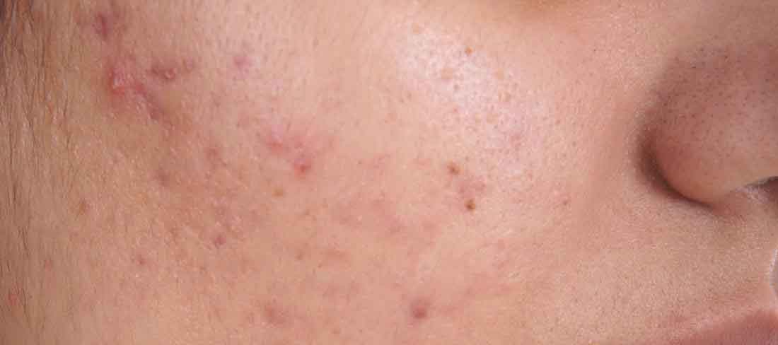 gel aloe vera-acne